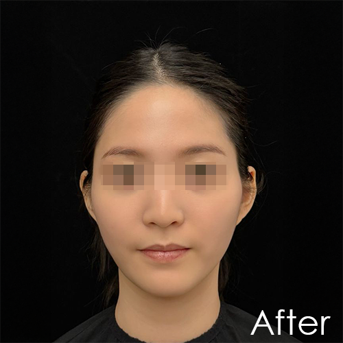 Post-facelift treatment photo of Michelle showing improved skin tightness and facial contour