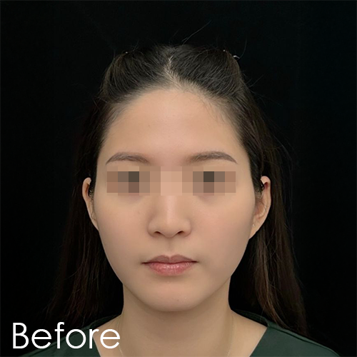 Pre-facelift treatment photo of Michelle showing before results