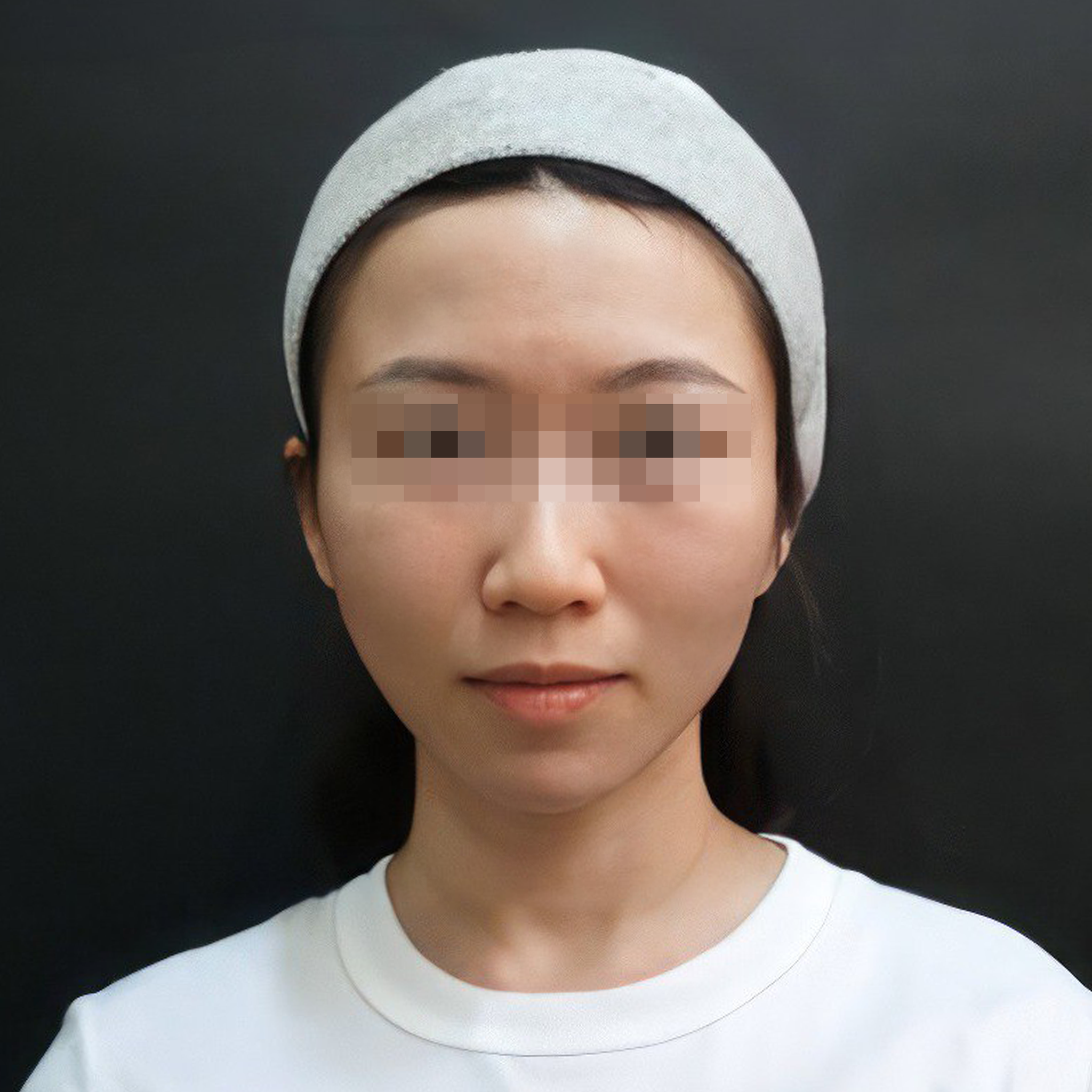 Miki Dermal Fillers After treatment photo