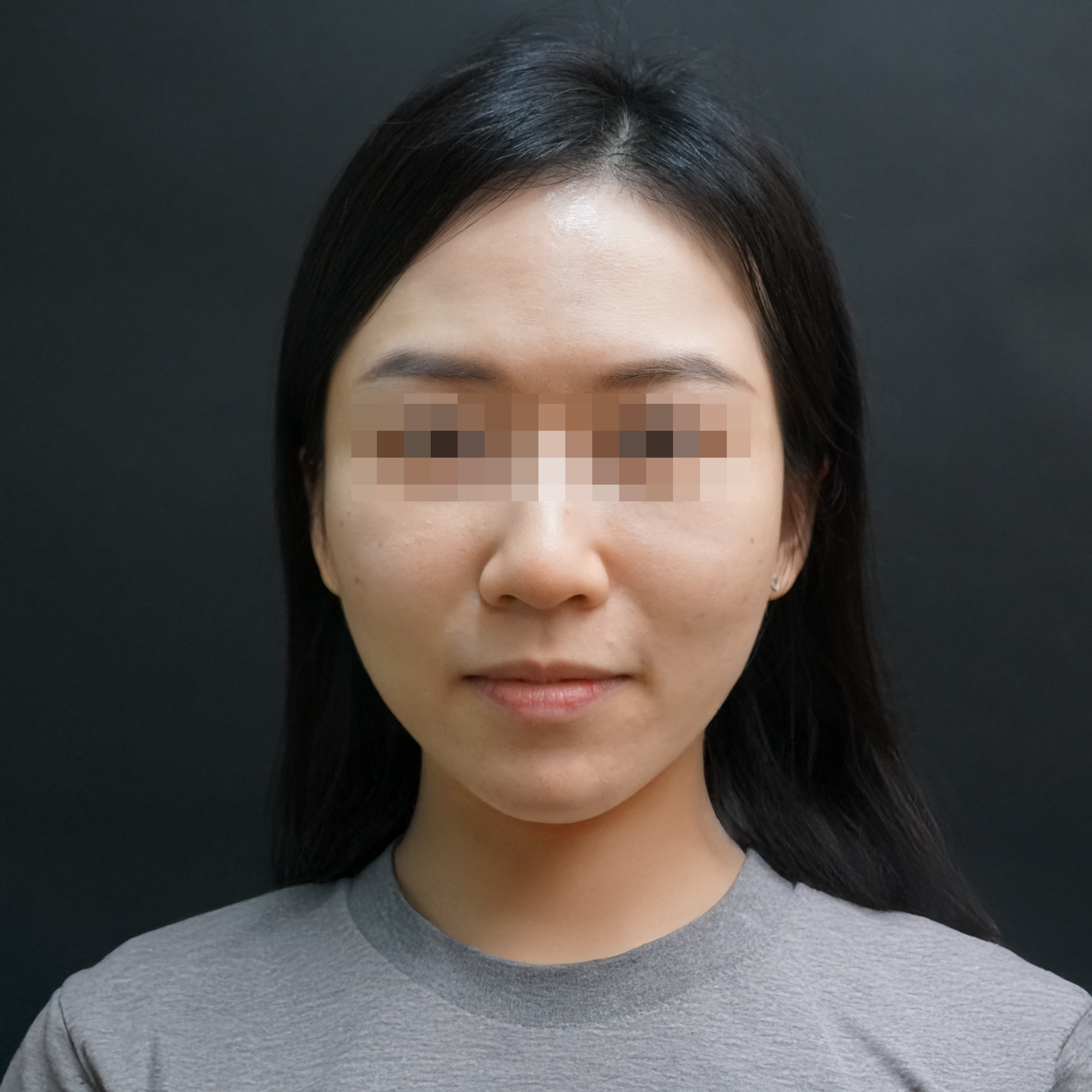 Miki Dermal Fillers Before treatment photo