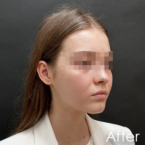 Patient after Polynucleotide Plinest treatment