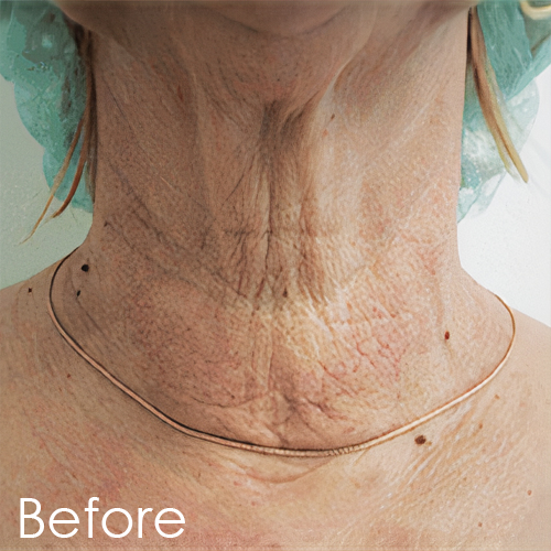 Patient’s skin before Polynucleotide Plinest treatment, showing initial texture and fine lines
