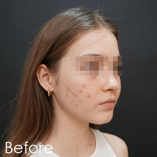 Patient before Polynucleotide Plinest treatment