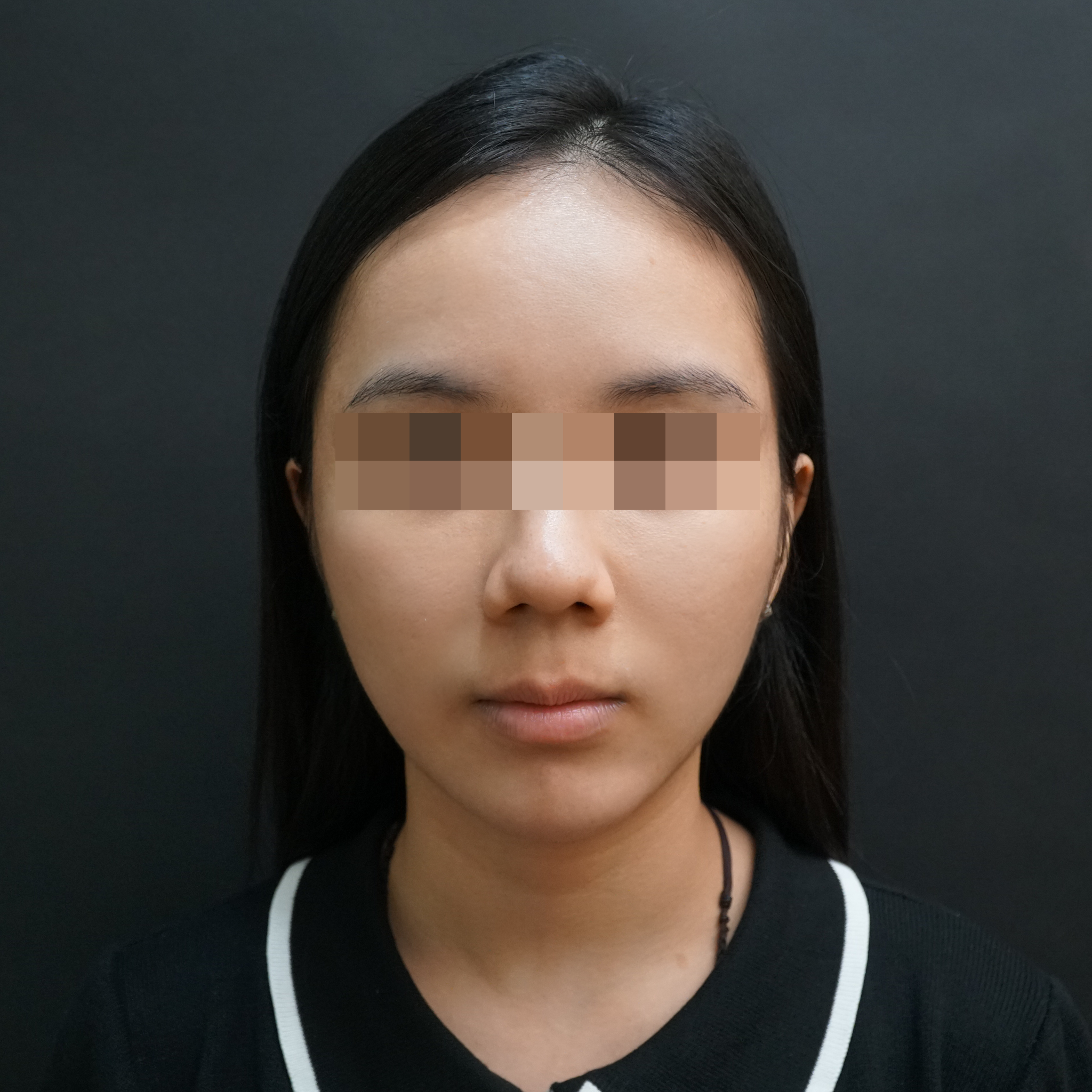 Puisan Dermal Fillers After treatment photo