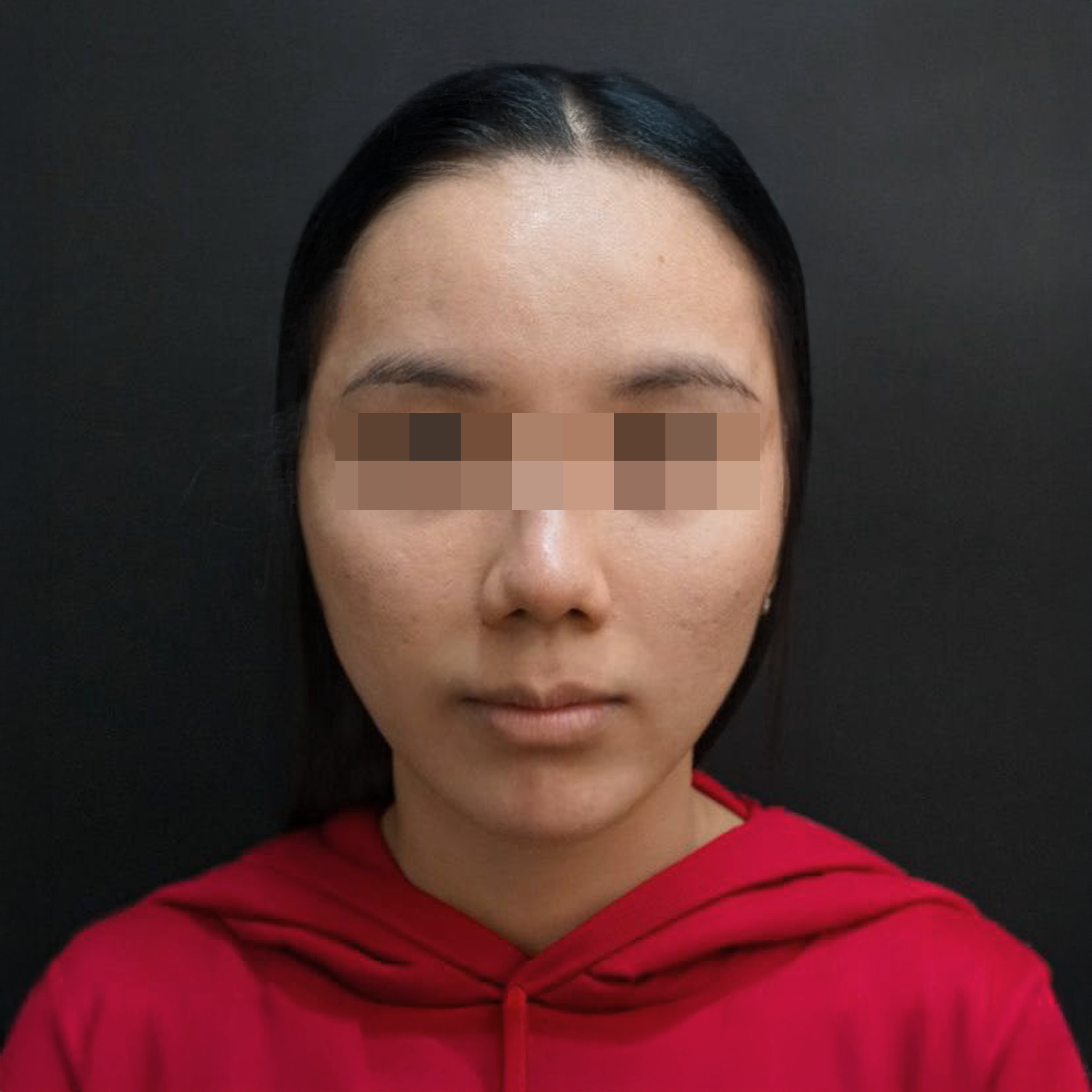 Puisan Dermal Fillers Before treatment photo