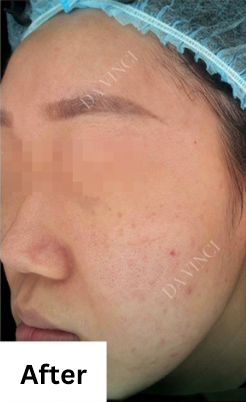 Patient after Acne Scar treatment, showing smoother complexion and reduced scarring