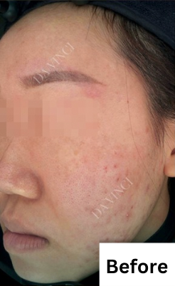 Patient before Acne Scar treatment, showing active acne and uneven skin texture