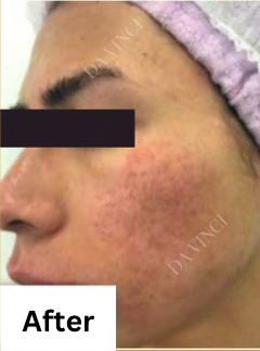 Patient2 after Acne Scar treatment, showing active acne and uneven skin texture
