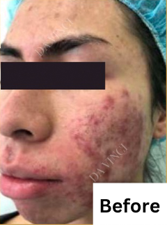 Patient2 before Acne Scar treatment, showing active acne and uneven skin texture
