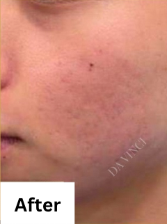 Patient3 after Acne Scar treatment, showing active acne and uneven skin texture