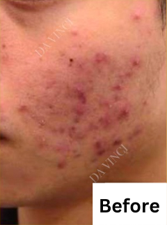 Patient3 before Acne Scar treatment, showing active acne and uneven skin texture
