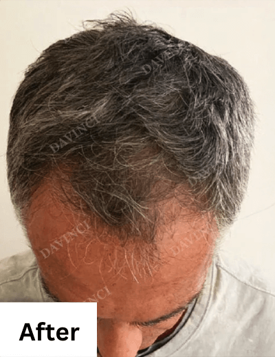 Hair loss treatment patient3 - after
