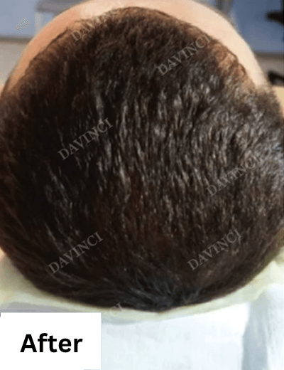 Hair loss treatment patient2 - after