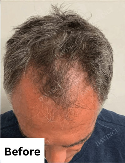 Hair loss treatment patient3 - before