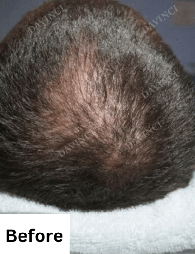 Hair loss treatment patient2 - before