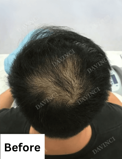 Hair loss treatment patient - before