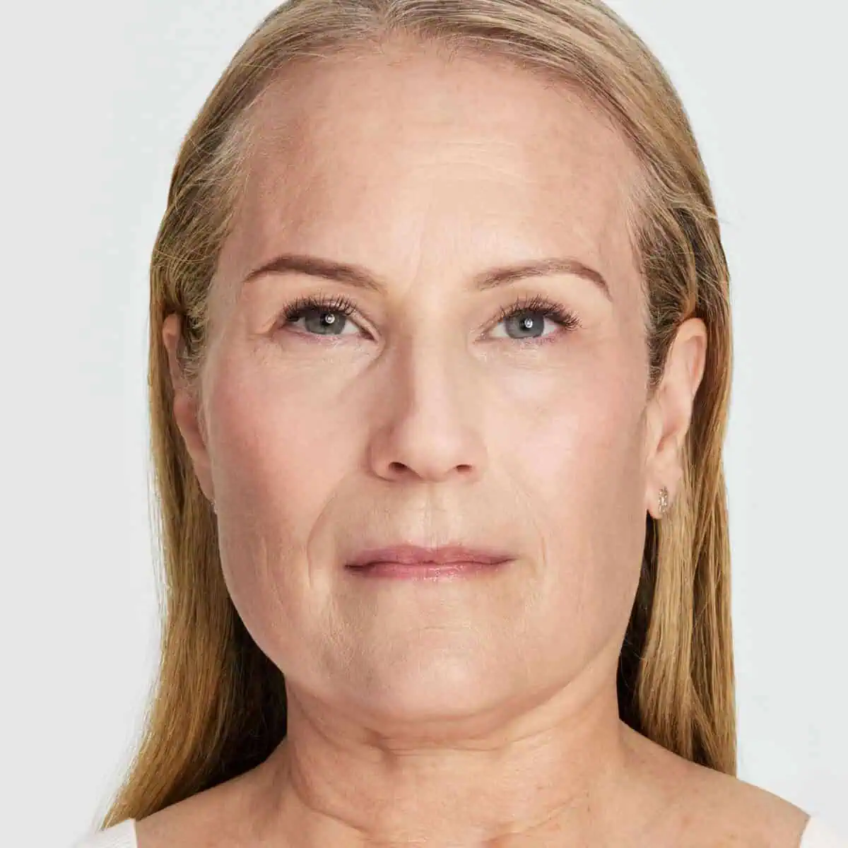 Ultherapy Prime patient – after treatment (right side)