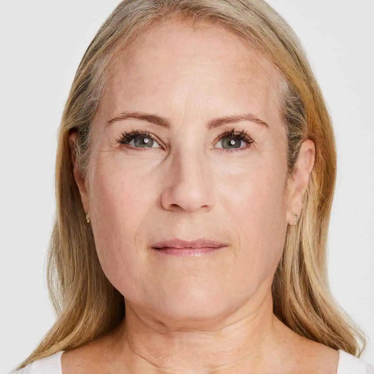 Ultherapy Prime patient – before treatment (left side)