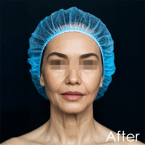 Post-facelift treatment photo of Angie showing tighter skin, reduced jowls, and defined jawline