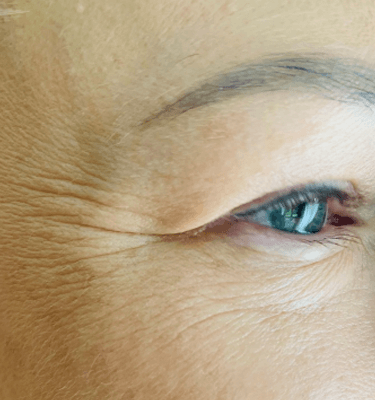 Juvelook treatment patient: fine wrinkles – after