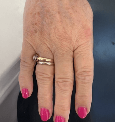 Juvelook treatment patient: dorsum of hands – after