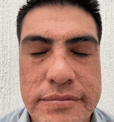 Juvelook treatment patient: atrophic scars – after