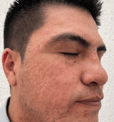 Juvelook treatment patient: atrophic scars – after