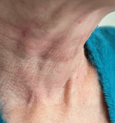 Juvelook treatment patient: neck wrinkles – after