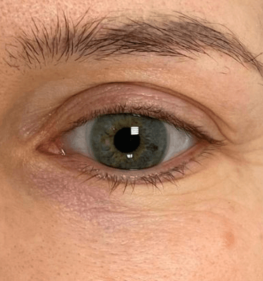 Juvelook treatment patient: tear trough – after