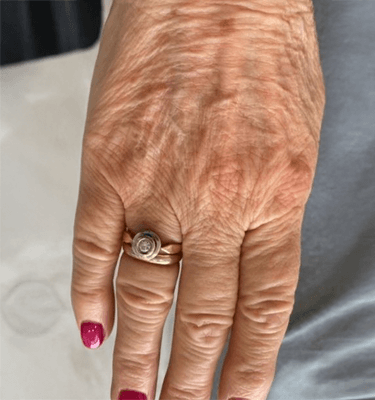 Juvelook treatment patient: dorsum of hands – before