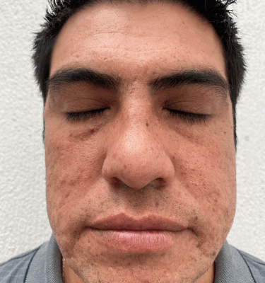 Juvelook treatment patient: atrophic scars – before