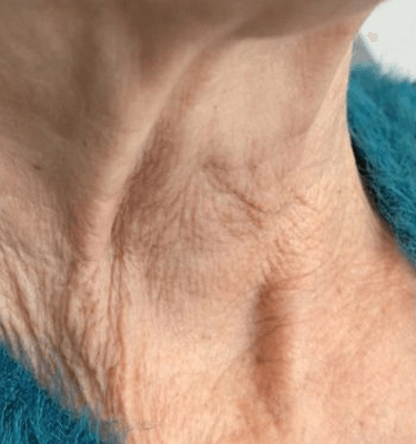 Juvelook treatment patient: neck wrinkles – before