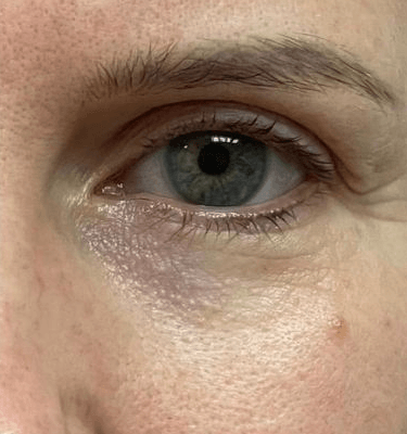 Juvelook treatment patient: tear trough – before