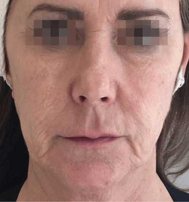 Profhilo treatment Face after