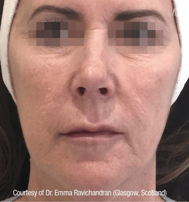 Profhilo treatment Face before