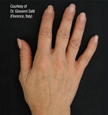 Profhilo treatment Hands after
