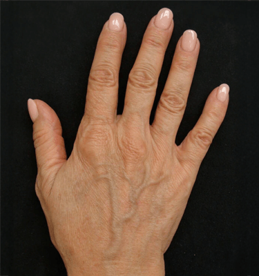 Profhilo treatment Hands before