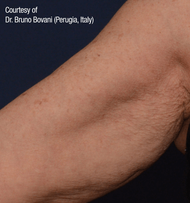 Profhilo treatment Inner Arms after
