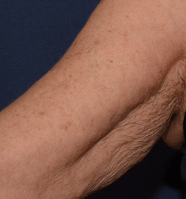 Profhilo treatment Inner Arms before