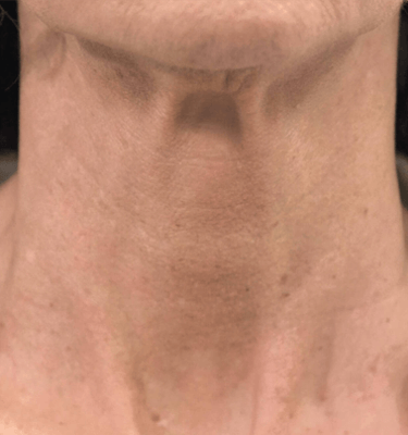 Profhilo treatment Neck after