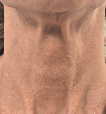 Profhilo treatment Neck before