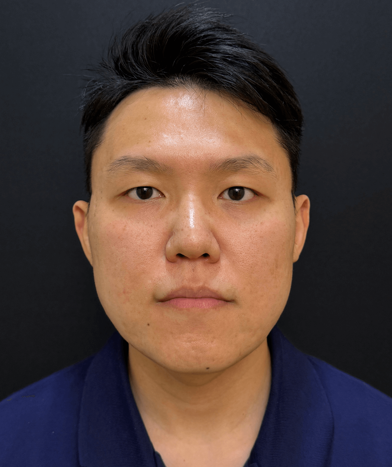Nicholas before UltraClear treatment