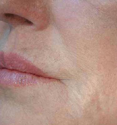 Profhilo treatment Perioral after