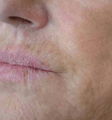 Profhilo treatment Perioral before