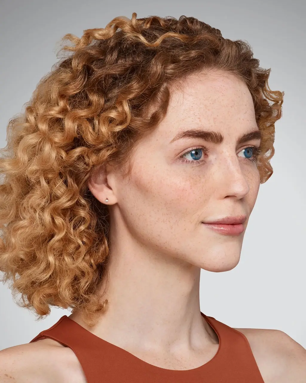 Addieson treatment after – Juvederm Dermal Fillers