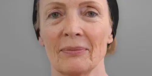 Ginette Ellanse treatment before