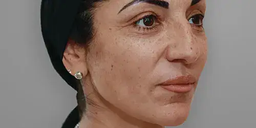 Hafiane Ellanse treatment before