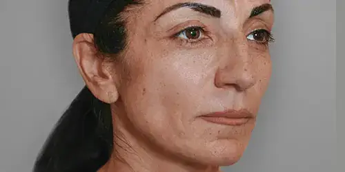 Hafiane Ellanse treatment after