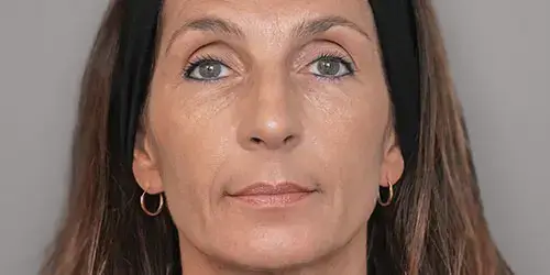 Marie Ellanse treatment after