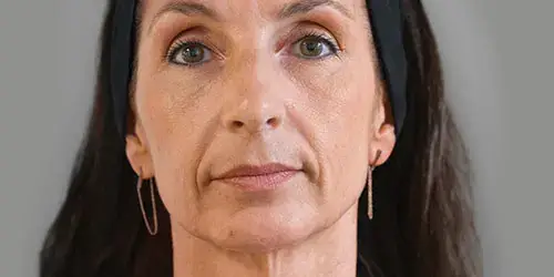 Marie Ellanse treatment before